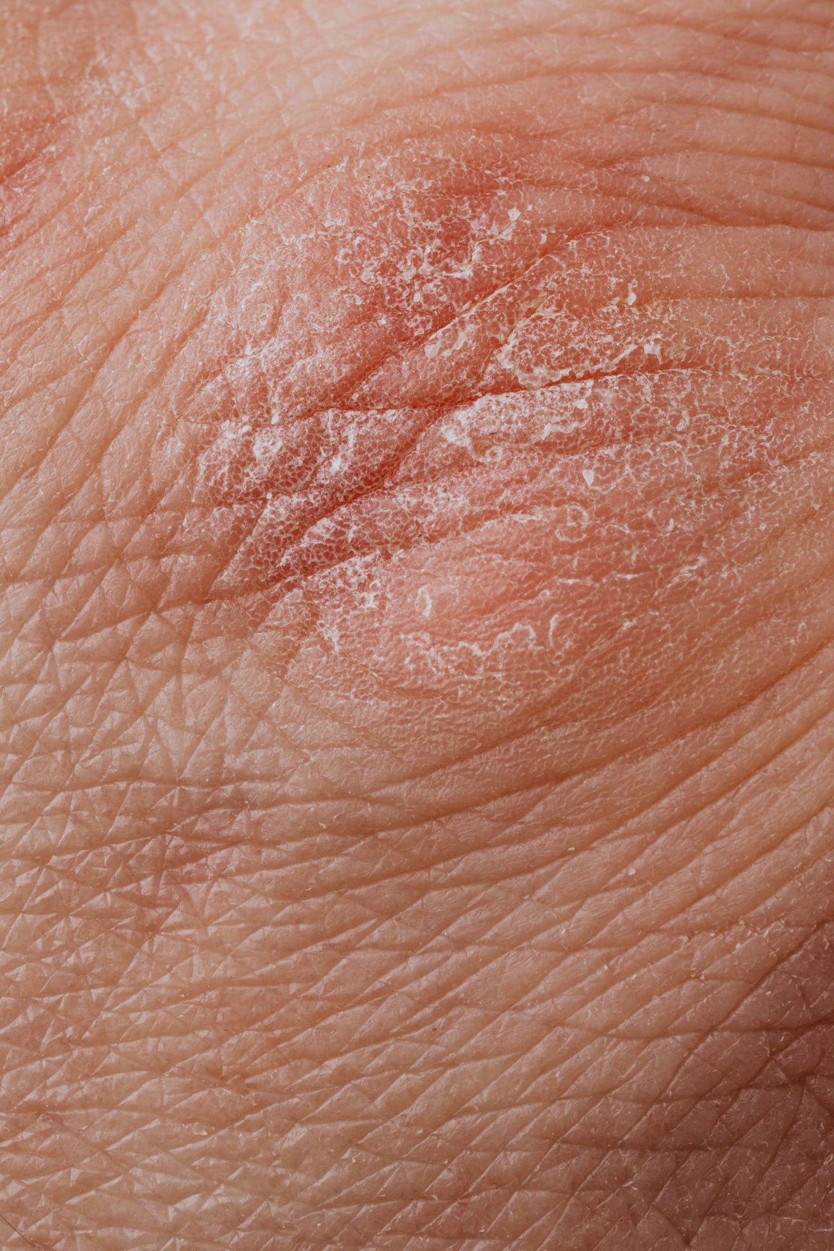 Online athlete's foot and ringworm treatment with I-Prescribe