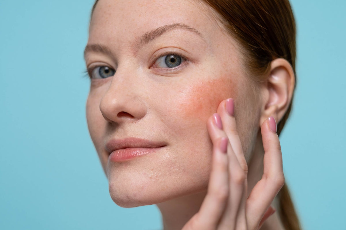 Online rosacea consultation with I-Prescribe Bradford